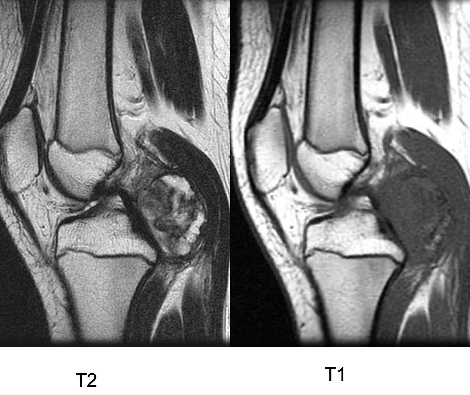 Figure 2 for case Synovial chondromatosis